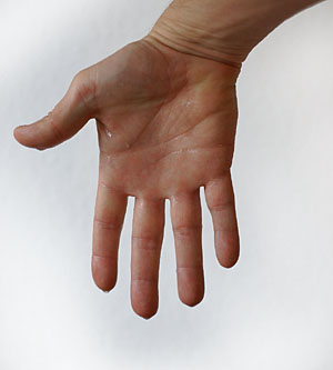 IPERIDROSI 3 - Mano